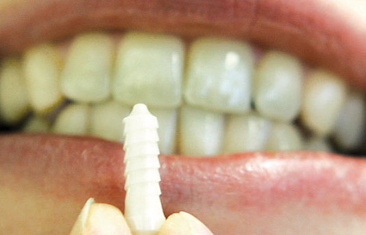 OsteoCer tooth implant| BioCer